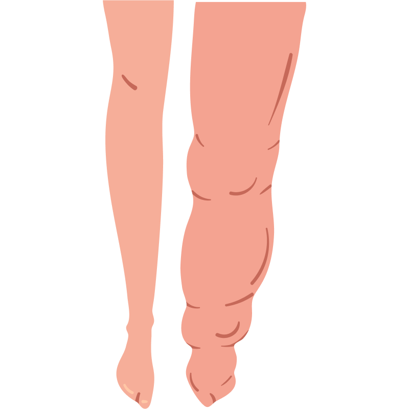 Legs with severe swelling, pronounced skin folds, and deformity. Legs with severe swelling, pronounced skin folds, and deformity.